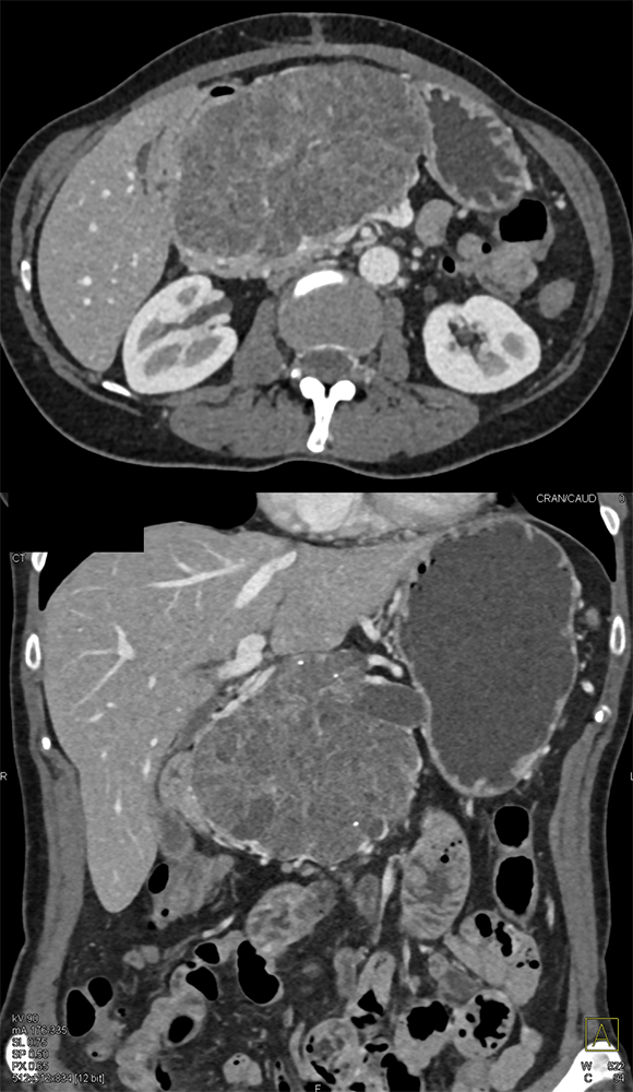 Detection of Pancreatic Cancer