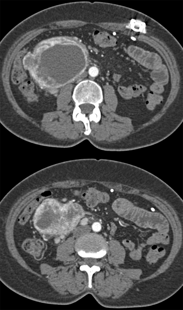 Cystic Neuroendocrine Tumor Pancreas