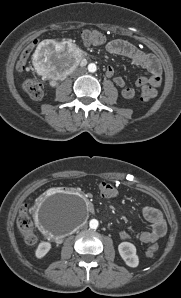 Detection of Pancreatic Cancer