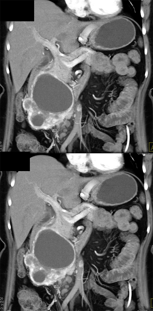 Detection of Pancreatic Cancer