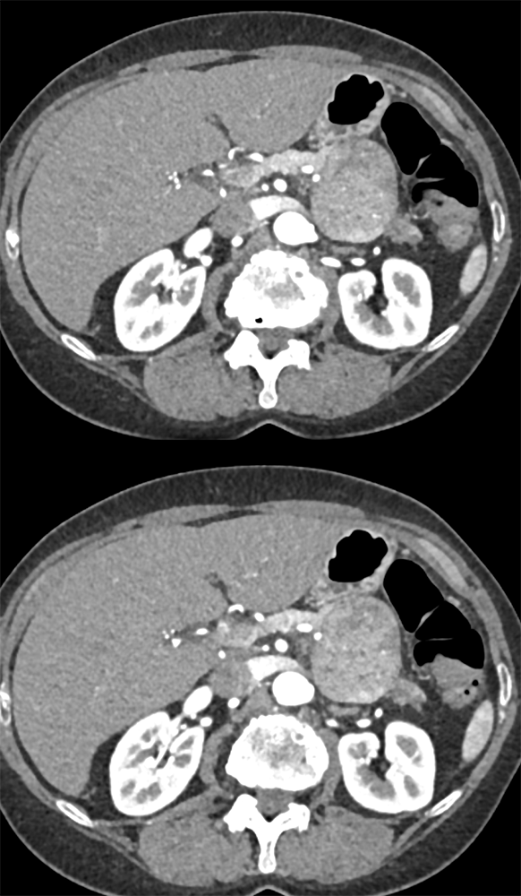 Uterine Leiomyosarcoma Metastatic to the Pancreas