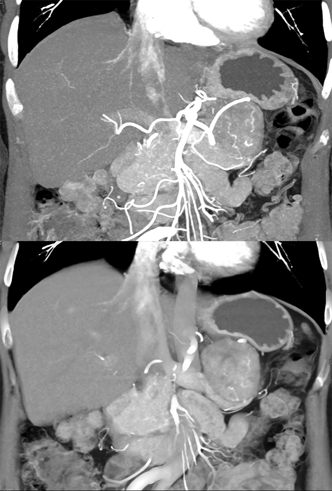 Detection of Pancreatic Cancer