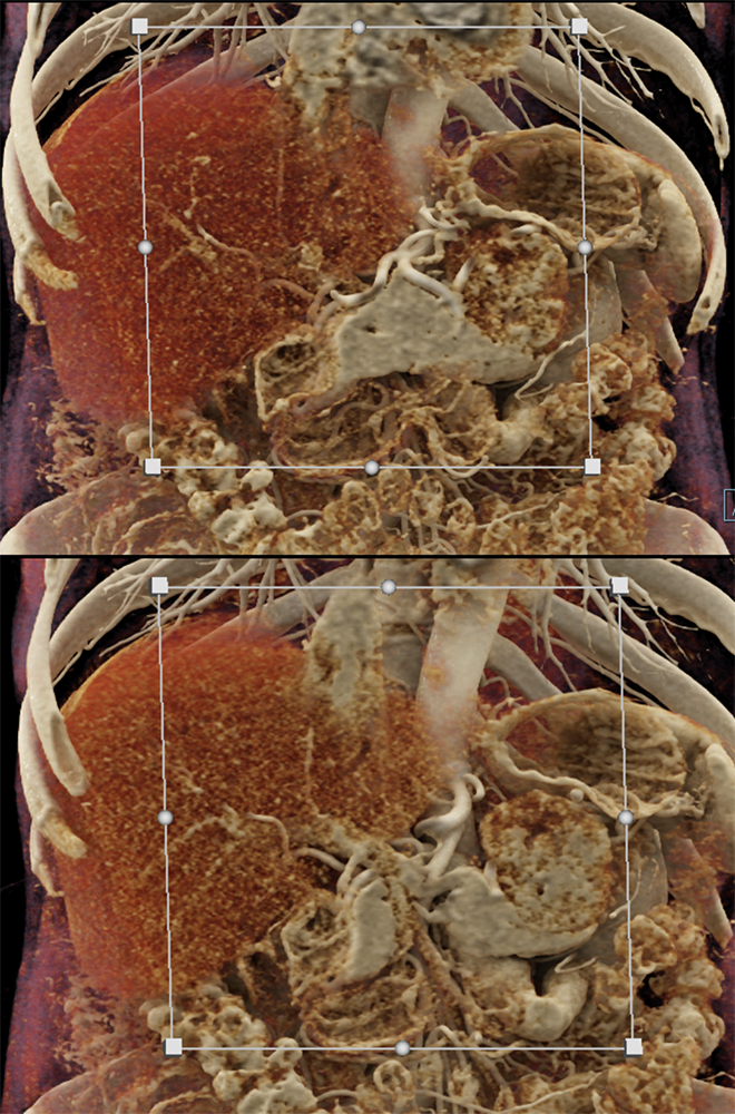 Detection of Pancreatic Cancer