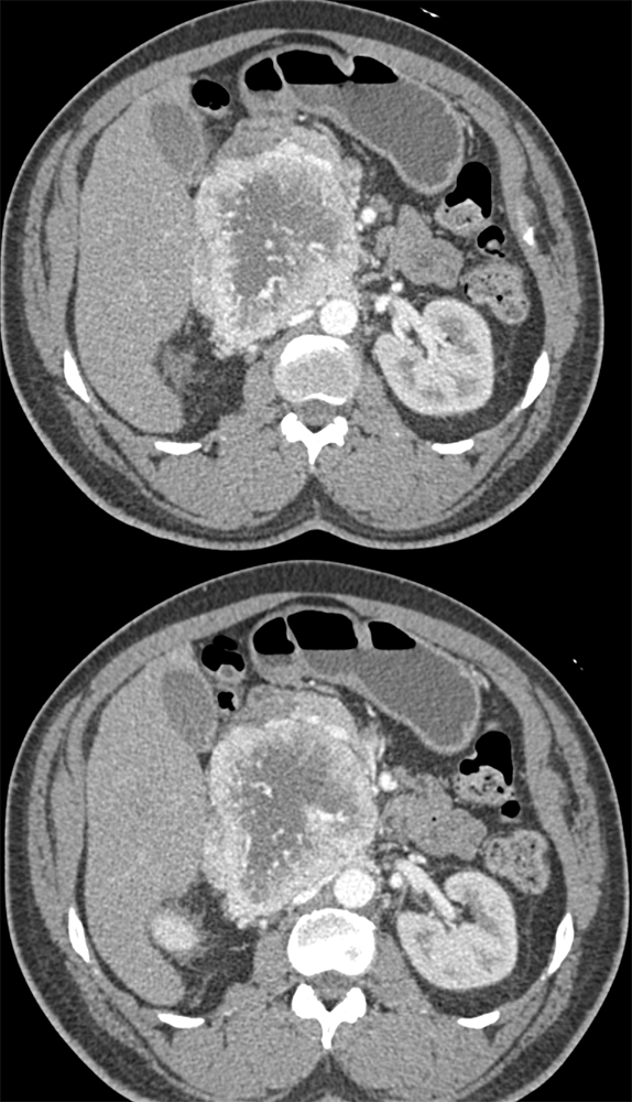 Paraganglioma Near HOP