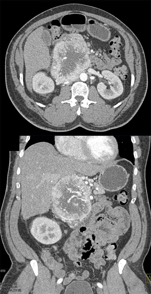 Detection of Pancreatic Cancer