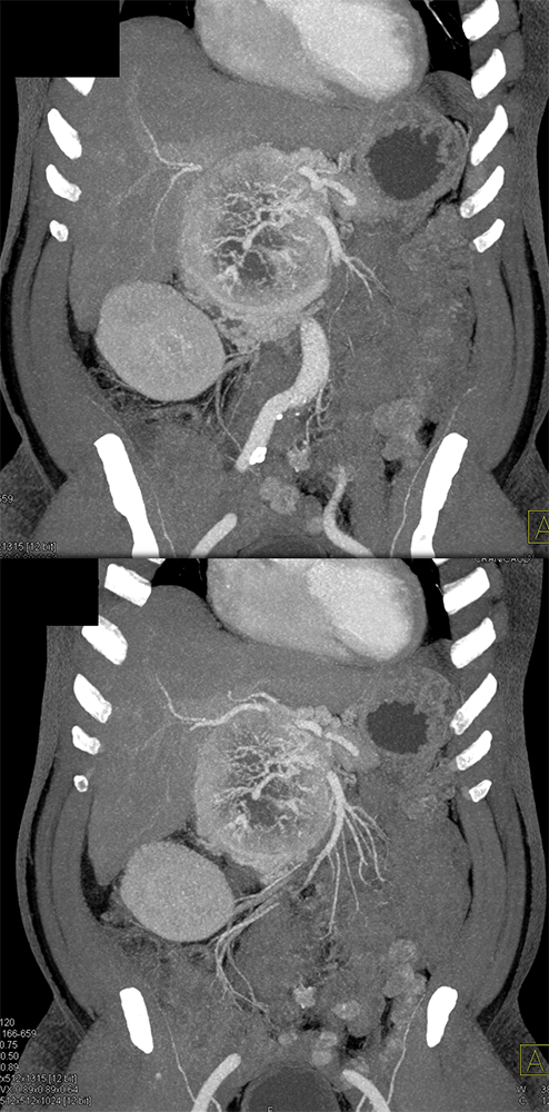 Detection of Pancreatic Cancer