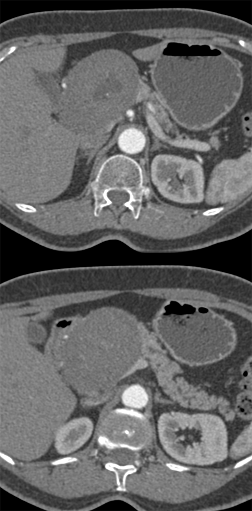 Suspected Pancreatic Mass was a Schwannoma