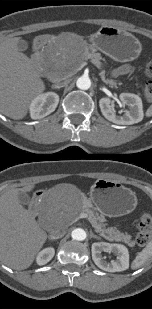 Detection of Pancreatic Cancer