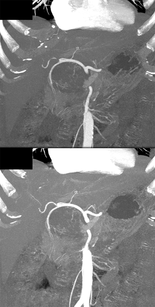 Detection of Pancreatic Cancer