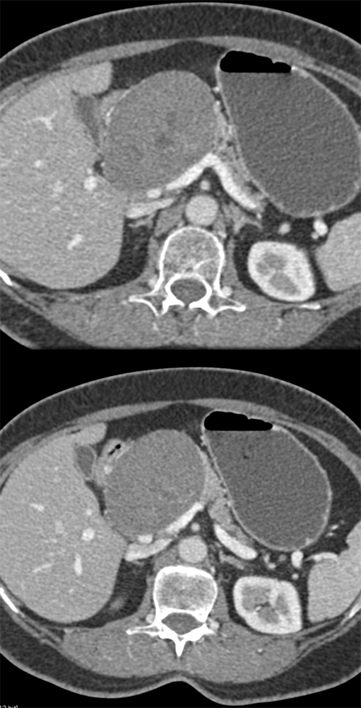 Detection of Pancreatic Cancer