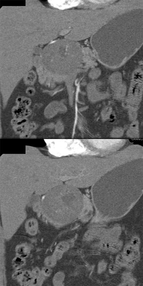 Detection of Pancreatic Cancer