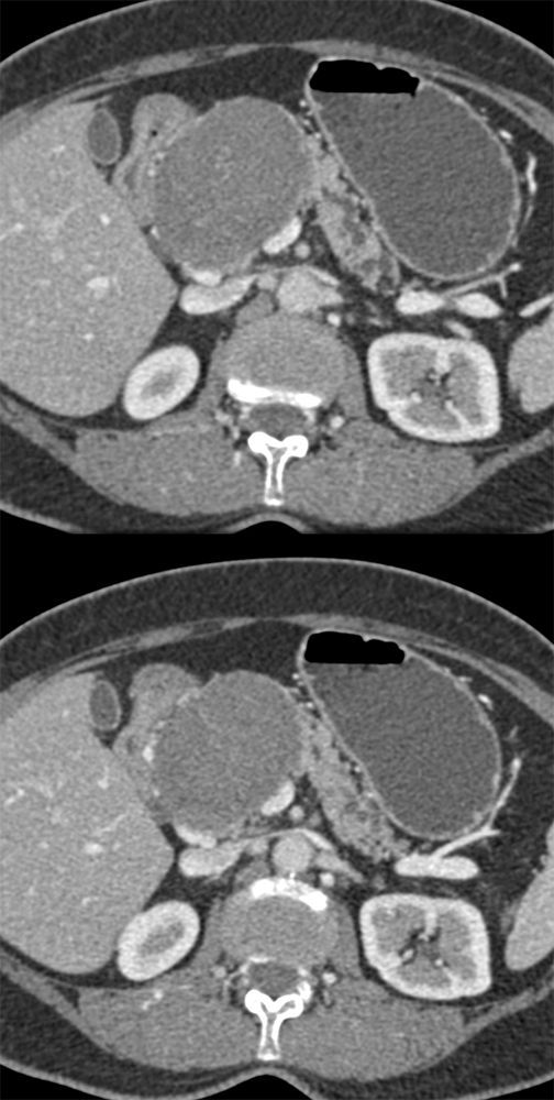 Detection of Pancreatic Cancer