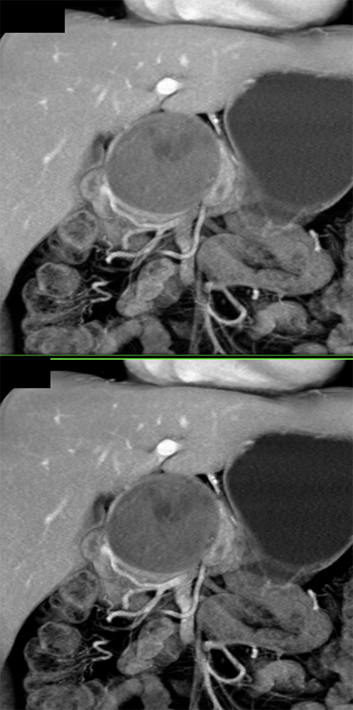 Detection of Pancreatic Cancer