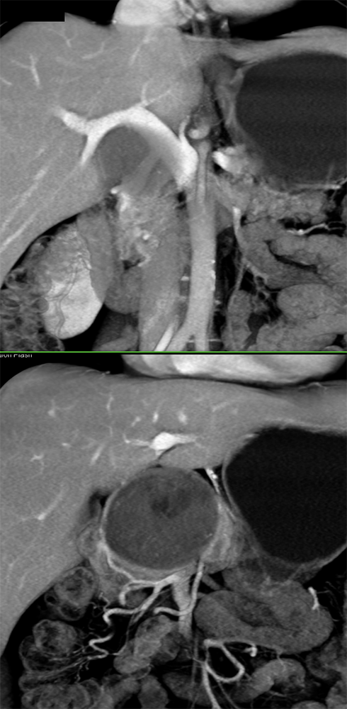 Detection of Pancreatic Cancer