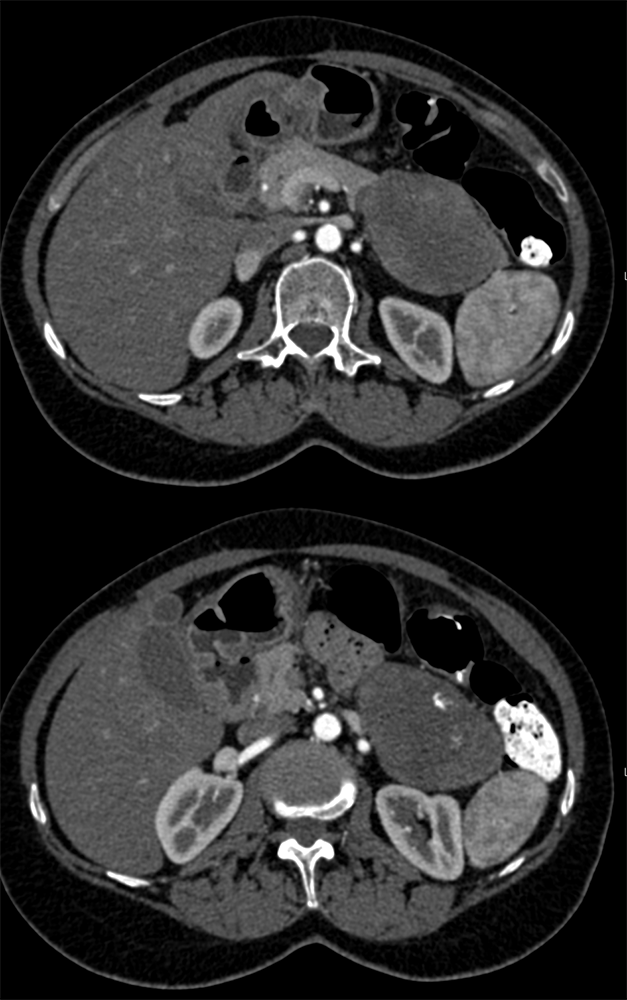 Adrenal Cortical Carcinoma Simulates a Pancreatic Mass