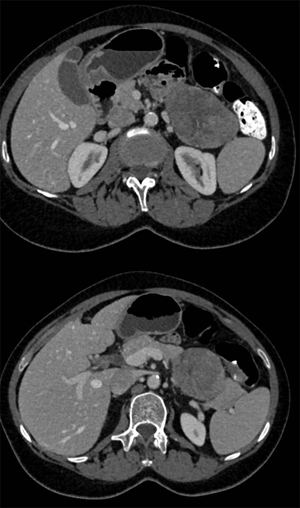 Detection of Pancreatic Cancer