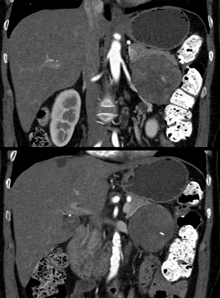 Detection of Pancreatic Cancer