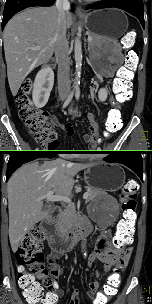 Detection of Pancreatic Cancer