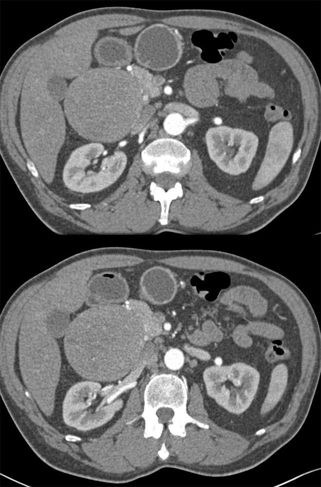 GIST Tumor Duodenum Presented as a Suspected Pancreatic Head Tumor