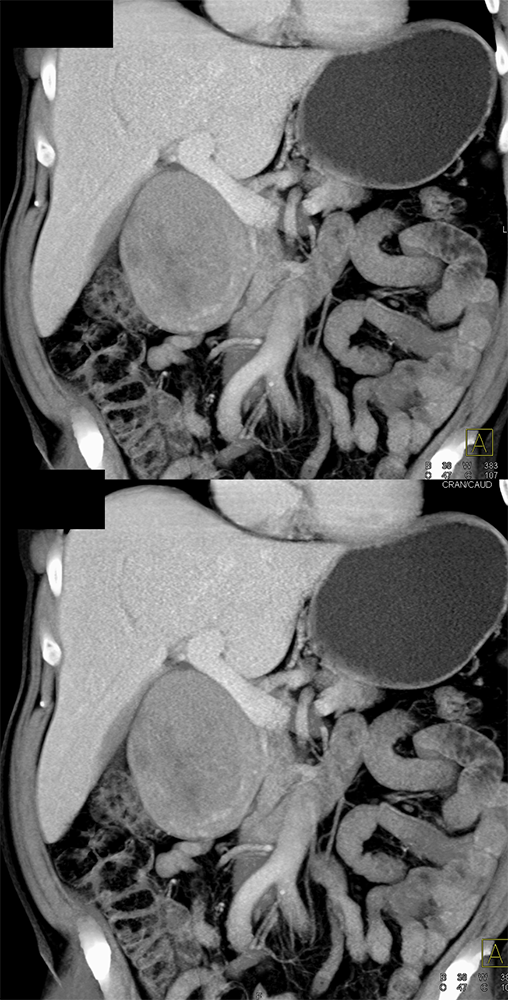 Detection of Pancreatic Cancer