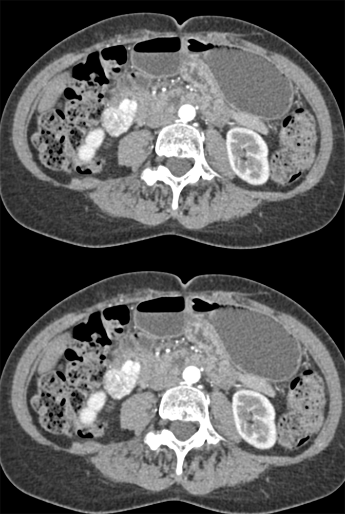 Duodenal GIST Tumor