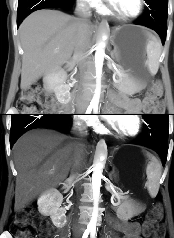 Detection of Pancreatic Cancer