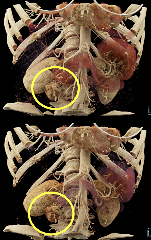 Detection of Pancreatic Cancer