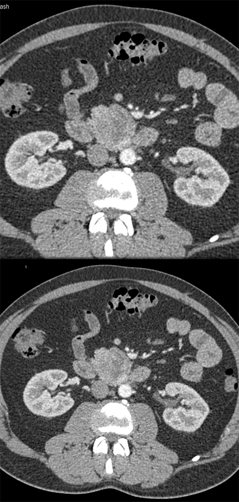 GIST Tumor Duodenum Simulates Pancreatic Mass