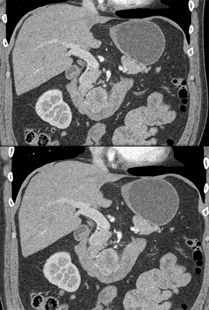 Detection of Pancreatic Cancer