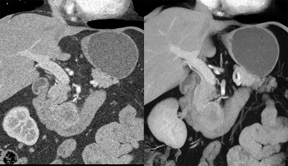 Detection of Pancreatic Cancer