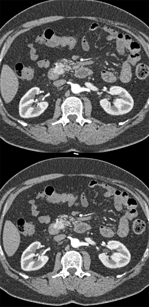 Duodenal GIST Tumor near Ampulla