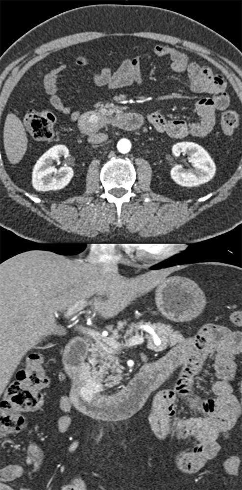 Detection of Pancreatic Cancer