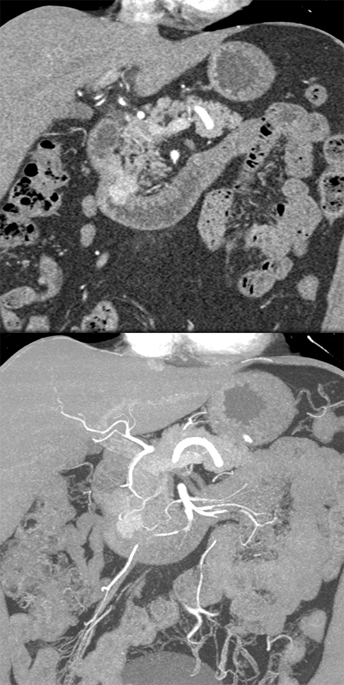 Detection of Pancreatic Cancer