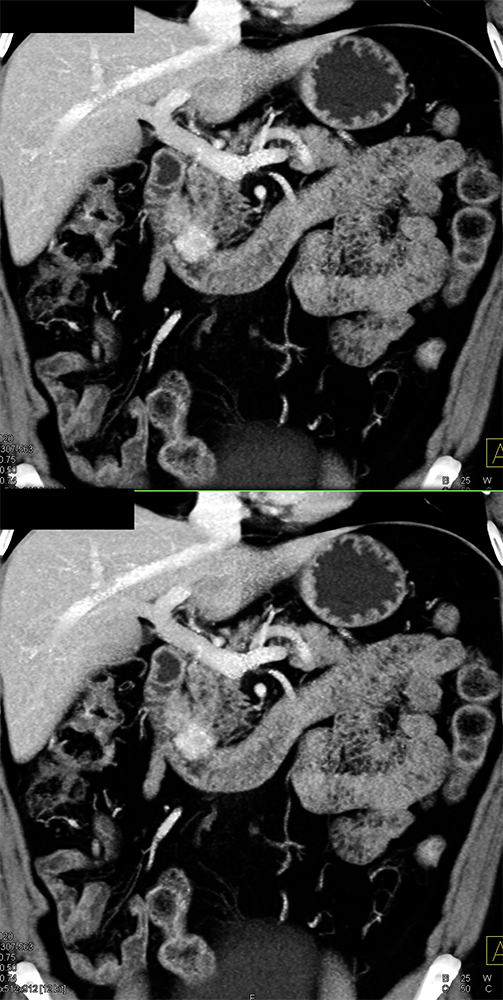 Detection of Pancreatic Cancer