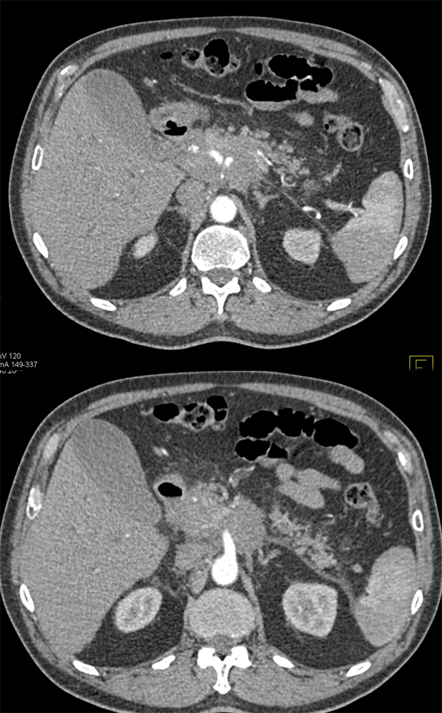 Follicular Lymphoma Simulates Pancreatic Cancer