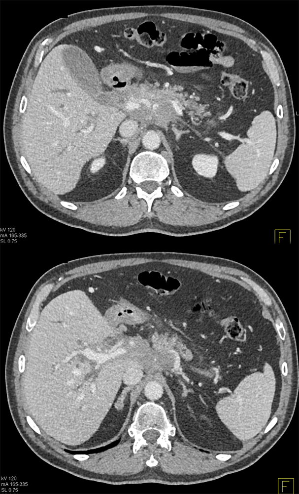 Detection of Pancreatic Cancer