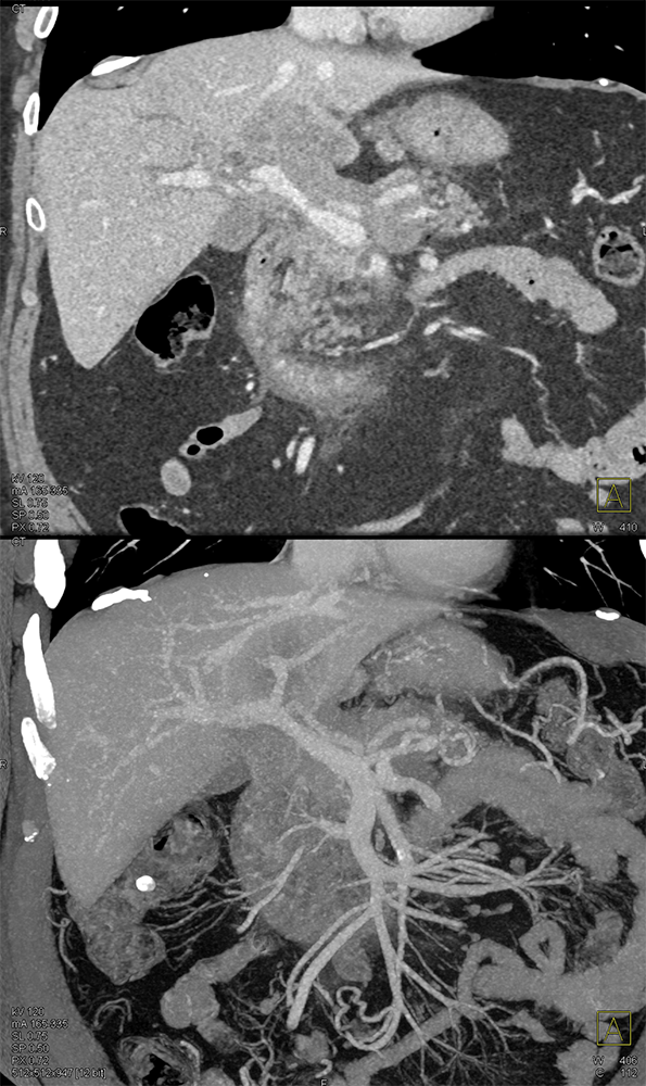 Detection of Pancreatic Cancer