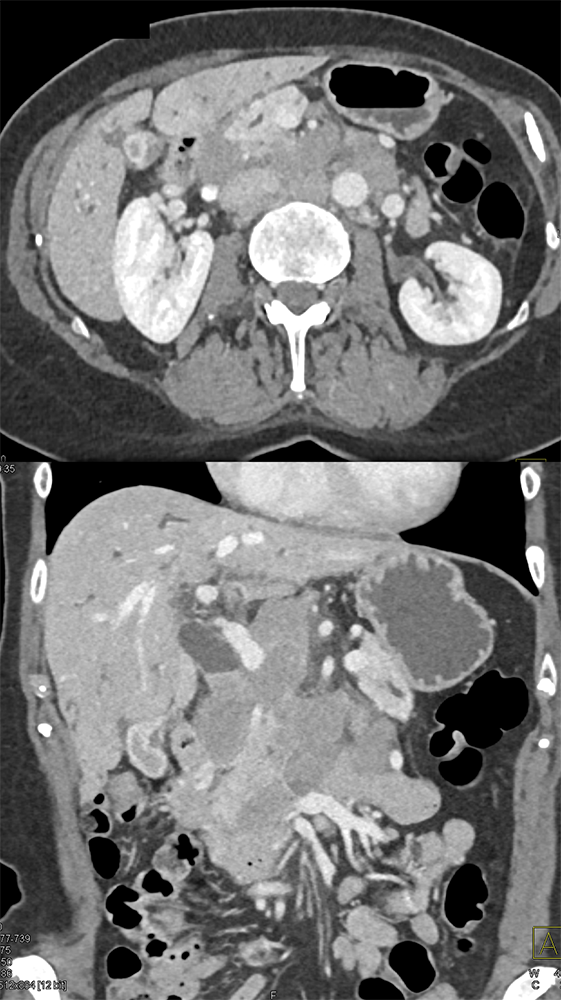 Detection of Pancreatic Cancer