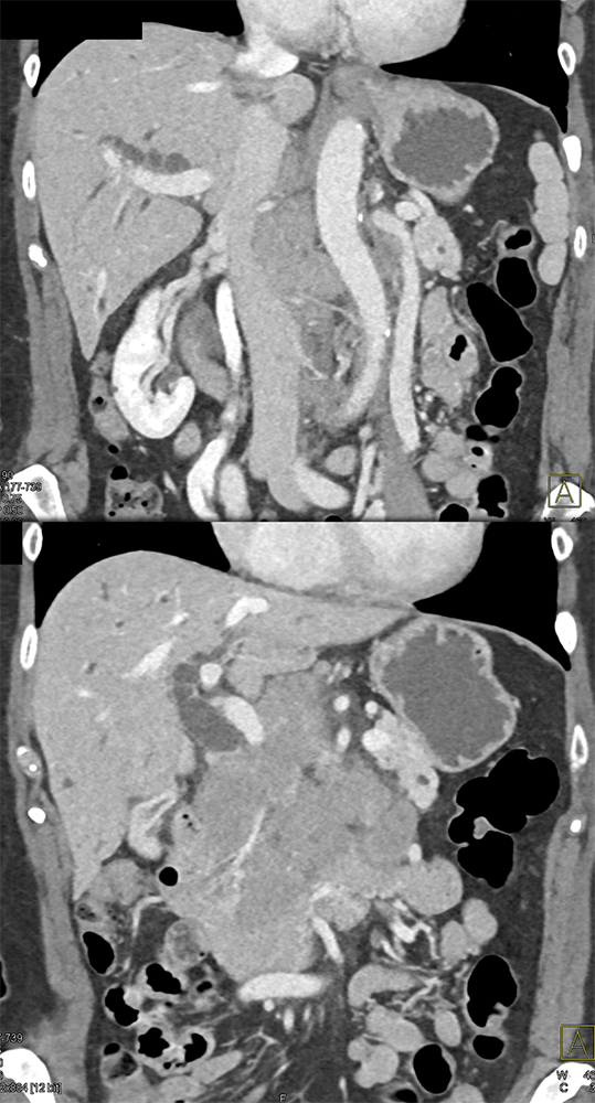 Detection of Pancreatic Cancer