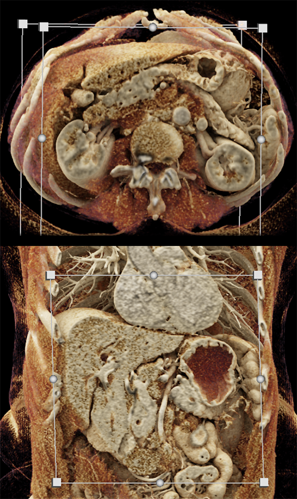 Detection of Pancreatic Cancer