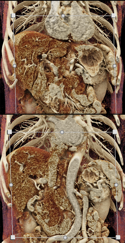 Detection of Pancreatic Cancer