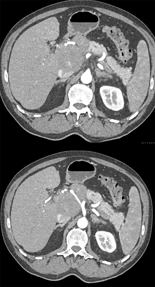 B-Cell Lymphoma