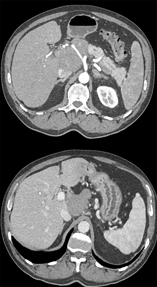 Detection of Pancreatic Cancer