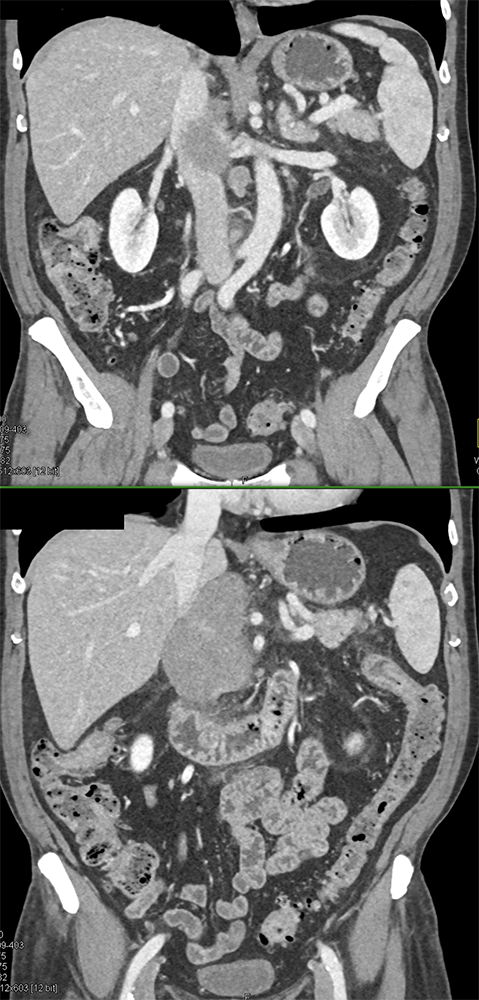 Detection of Pancreatic Cancer