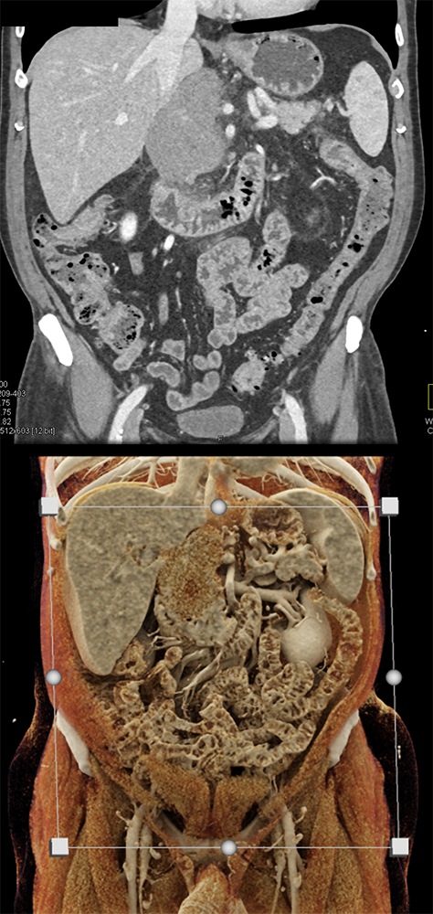 Detection of Pancreatic Cancer