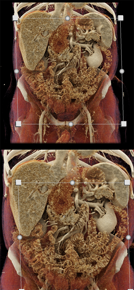 Detection of Pancreatic Cancer