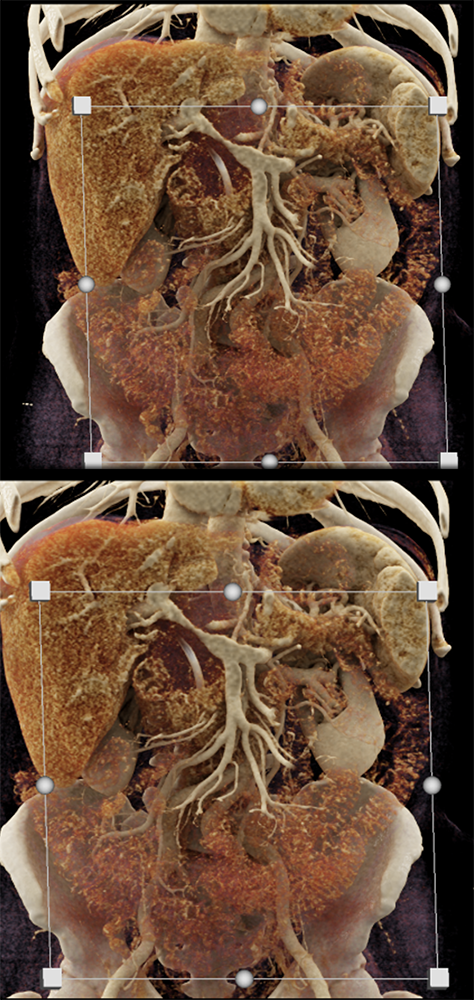 Detection of Pancreatic Cancer