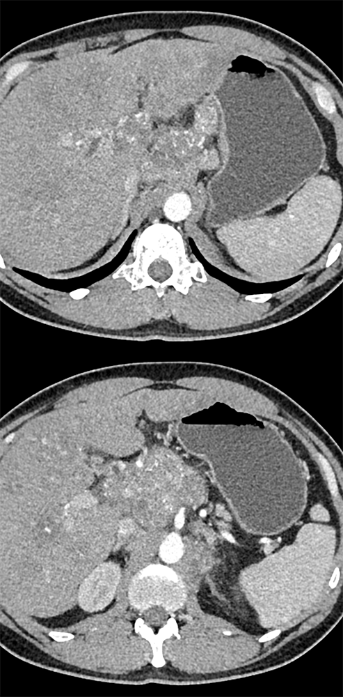 Metastatic Colon Cancer Near Pancreas