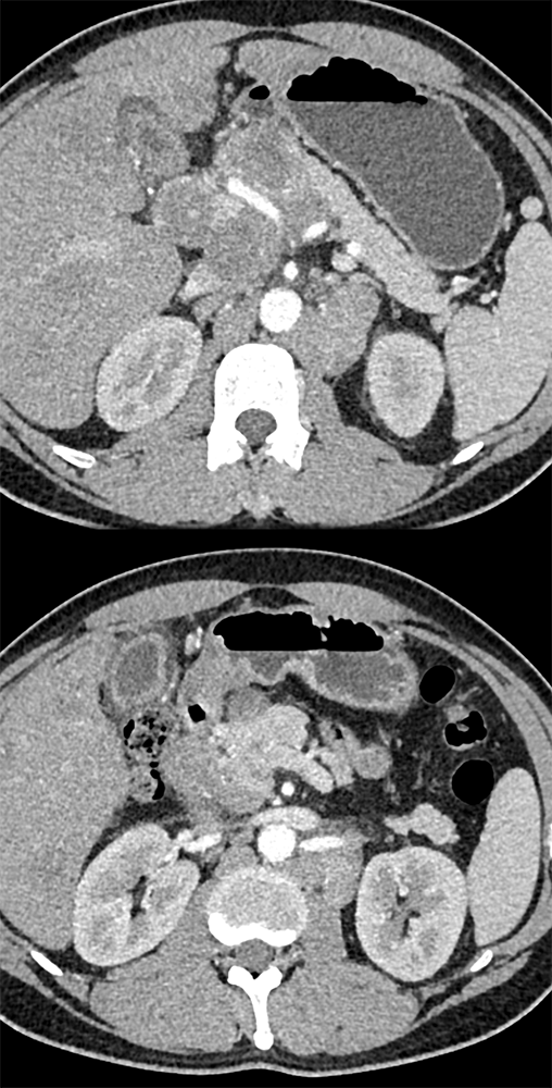 Detection of Pancreatic Cancer