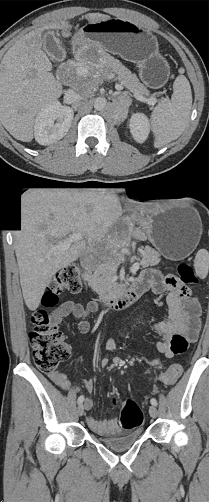 Detection of Pancreatic Cancer